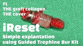 Explantation (Implant removal) with Trephine Bur Kit & iReset with The Graft Collagen / THE cover