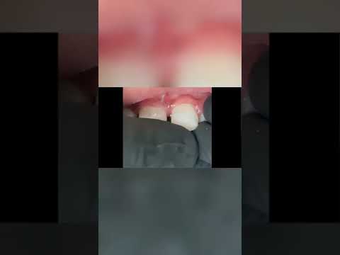 Reattachment of fractured teeth. #dentist #dentaltrauma #toothfracture