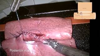 Robotic Surgery - Gastrojejunostomy LEARNBOT Instruction Video