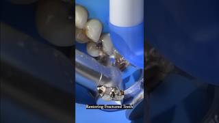 Restoring Severely Damaged Teeth With Biomimetic Dentistry 💪🛡️ #readdescription #dentist