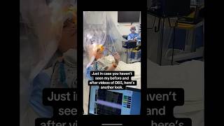Another look at my DBS surgery videos….before and after the leads are placed.