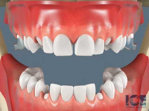 Quad Helix Appliance