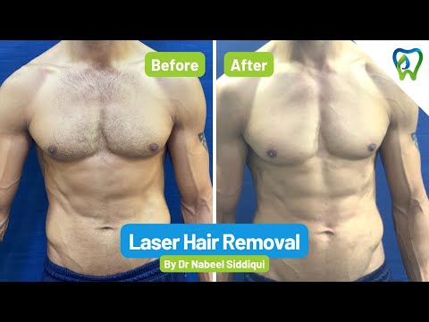 Laser Hair Removal Treatment- Complete Procedure- Dr. Nabeel Clinic