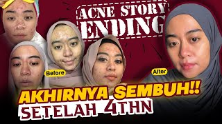 Cara mengatasi jerawat on off akhirnya sembuh dengan HALODOC! Setelah 4 tahun berjuang