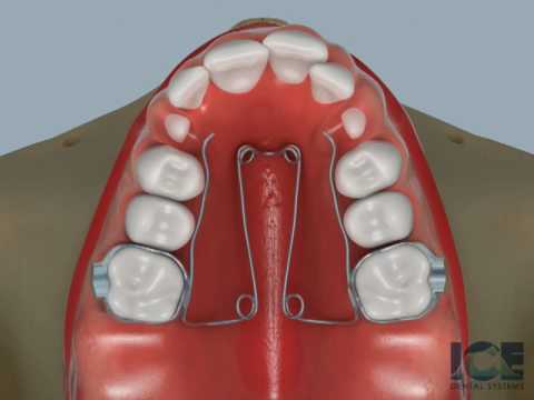 Quad Helix Appliance Part 2