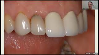 Porcelain Restorations vs Bioclear Lecture