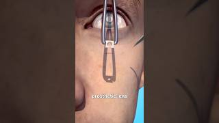 Tooth In Eye Surgery 😨 Surgeon Reacts