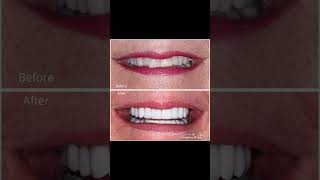 Check out this incredible transformation!#beforeandafter#confidenceboost#smilecorrection#sanantonio