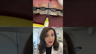 How You Can Clean Between Your Teeth When You Have Braces On?!