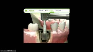 Extraction socket procedure with trephine