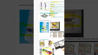 Ip DRG Training fusion procedure#rootoperation#pcs#ipdrg#medicalcodingonlinetraining#viralvideo