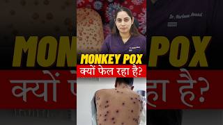 MonkeyPox Virus क्या है? MonkeyPox Virus के क्या लक्षण है?