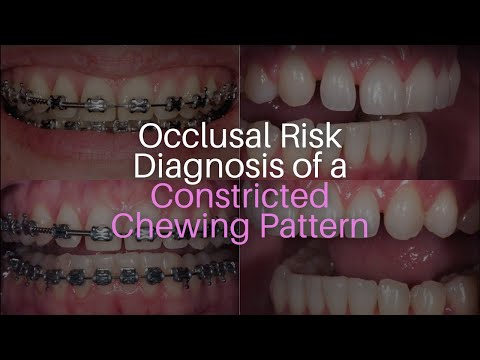 Occlusal Risk Diagnosis of a Constricted Chewing Pattern