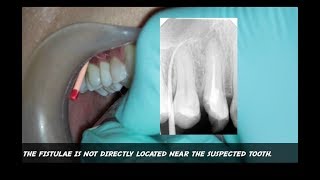 Tracing Sinus Tract With Gutta Percha Point TAKEN WITH XRAY IMAGE apical abscess tooth fistulae