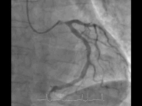 Left Main NSTEMI