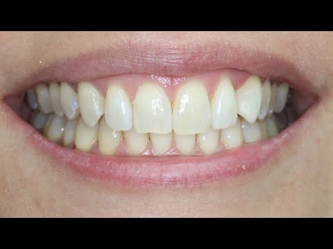 Before + After Smile Makeover | Goehring Dental South Austin, TX