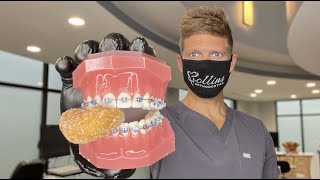 Braces And...Donuts?!?! 😳 It's Not What You Think...