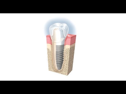 Single Dental Implant