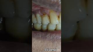 Class V restoration ! cervical abrasion cosmetic filling !Composite Restoration #shortvideo