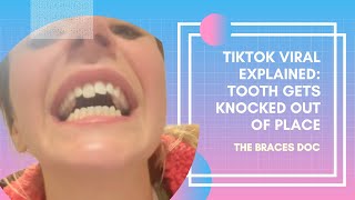 Tooth Emergency Popped Back into Place w/ Retainer (orthodontist explains) - TheBracesDoc