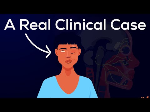 What is Bell's Palsy? Causes, Symptoms, Pathophysiology, & Treatments