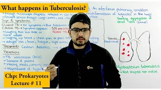 Tuberculosis (TB) | Causes, Treatment, Prevention and Transmission
