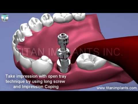 How to take Open tray impression and use stock abutment to make crown and bridge