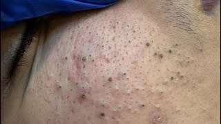 [ASMR] Blackhead and Whitehead Removal Therapy Session
