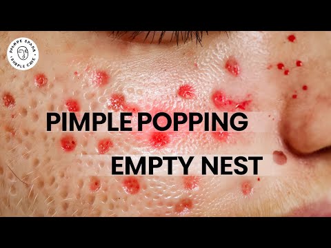 The Most Satisfying Blackhead Removals at Pimple Spa