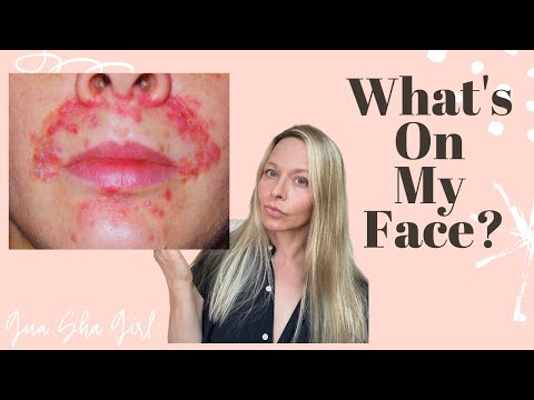 3 Skin Conditions That AREN'T Acne