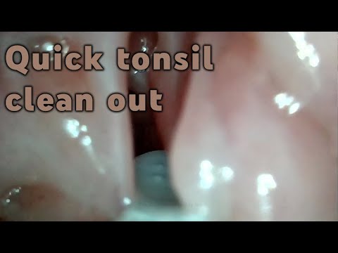 Quick Tonsil Stone Clean out | AIM 5
