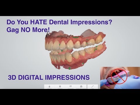 Hate Dental Impressions? 3D Digital Dental Impressions