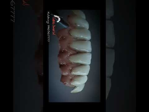 dental ceramics gingival characterization#kalaburagi #dentaltechnician#dentallab#trending #ivoclar