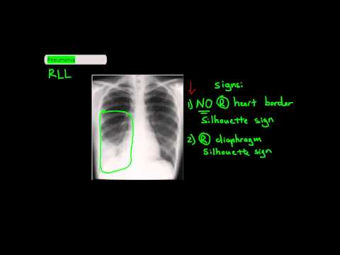 Identifying which Lung Lobe a Puemonia is in [UndergroundMed]