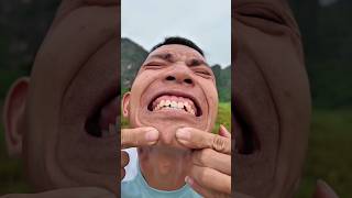 Survival Hack: Simple Acne Treatment wit