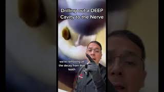 Preparing for a Root Canal: Removing the Cavity | In Office to Hands On Dental Training