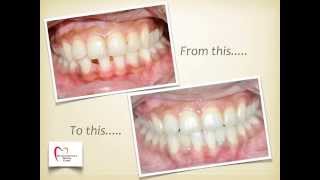 Smile Enhancement with Implants Ortho Case