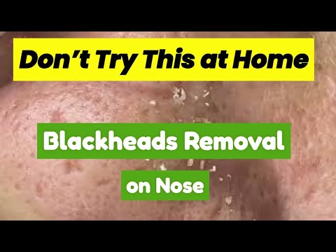 Top Dermatologist Reveals Worst Mistakes in Blackhead Removal on Nose | Pimple Spa