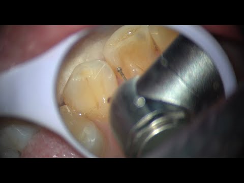 Class III cavity preparation Upper Lateral Incisor