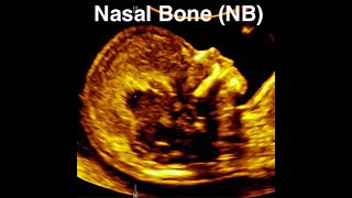 Nasal bone assessment and absent nasal bone at 11-13 weeks