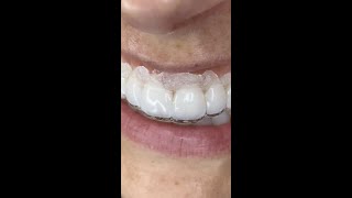 Is It Bad To Use Retainers To Whiten Your Teeth? 🤔 Orthodontist Reacts!