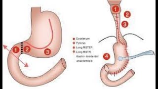 Esophagoplasty CPT code - simplify medical coding