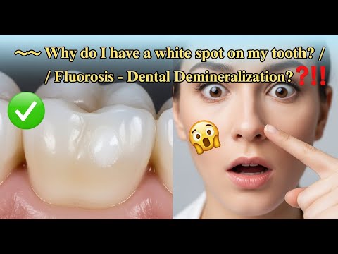 ✅ Why do I have a white spot on my tooth? / Fluorosis - Dental Demineralization? 😳👈