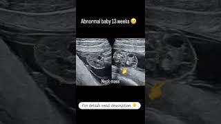 Abnormal NT scan Showing Neck Swelling at 13 Weeks of Pregnancy