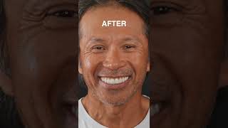 BEFORE AND AFTER DENTAL IMPLANT TRANSFORMATION!