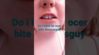#BracesGuy I meant overbite