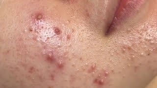 asmr satisfying facial blackhead removal,blackhead removal on face satisfying#001 