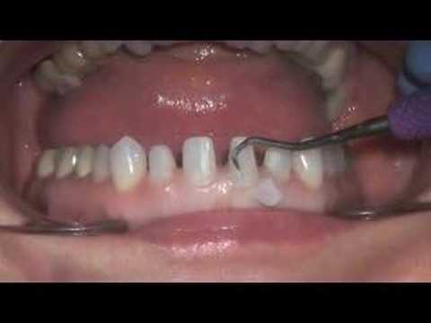 Veneer Temp Removal