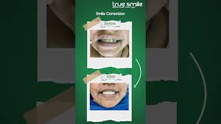 Smile Correction at True Smile Dental Clinic – Transform Your Smile, Transform Your Life ✨