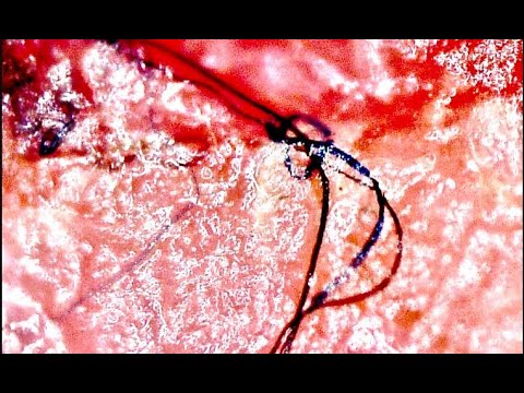 O que é a doença de Morgellons